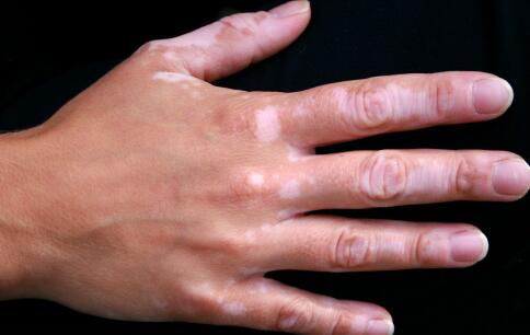 手指上患有白癜风原因是什么